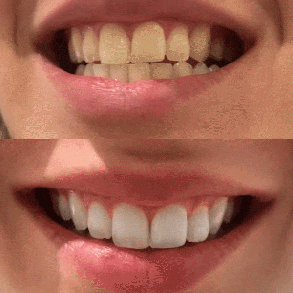 Lápiz Blanqueador Dental