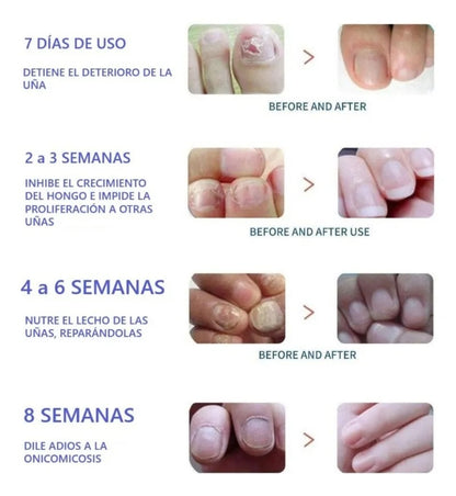 Parche anti hongos para uñas